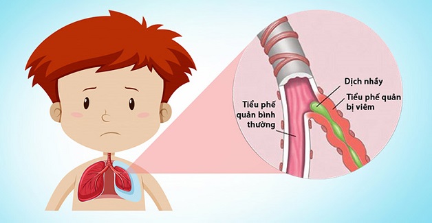 Viêm tiểu phế quản cấp là căn bệnh thường gặp ở trẻ em