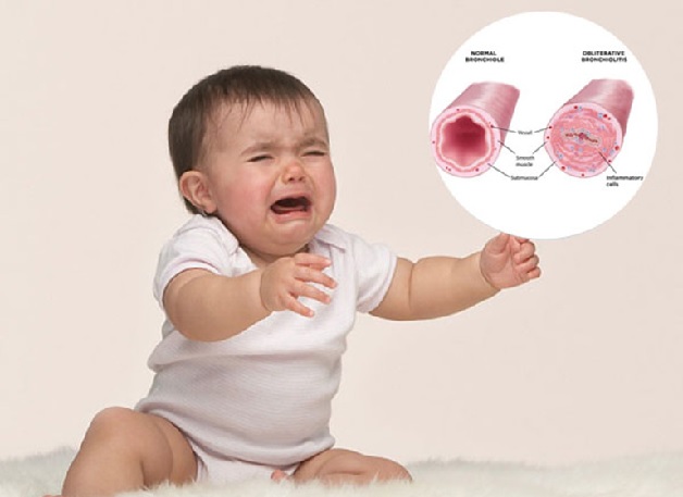 Viêm tiểu phế quản là căn bệnh thường gặp ở trẻ em