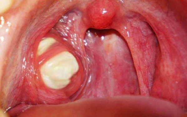 Viêm xoang cấp mủ là bệnh lý khi viêm xoang cấp tính đang dần chuyển sang giai đoạn mạn tính kèm theo sự xuất hiện của dịch mủ
