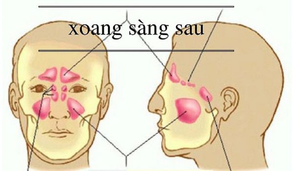 Khi các hang rỗng ở xương xoang bị viêm nhiễm gọi là viêm xoang sàng 2 bên