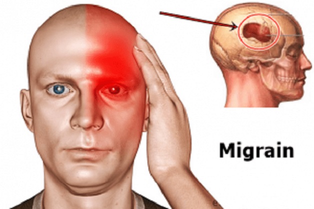 đau đầu do căn nguyên mạch máu