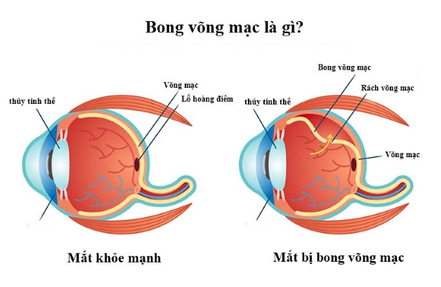 Bong võng mạc là bệnh lý sẽ xảy ra khi trên võng mạc xuất hiện một hoặc nhiều vết rách