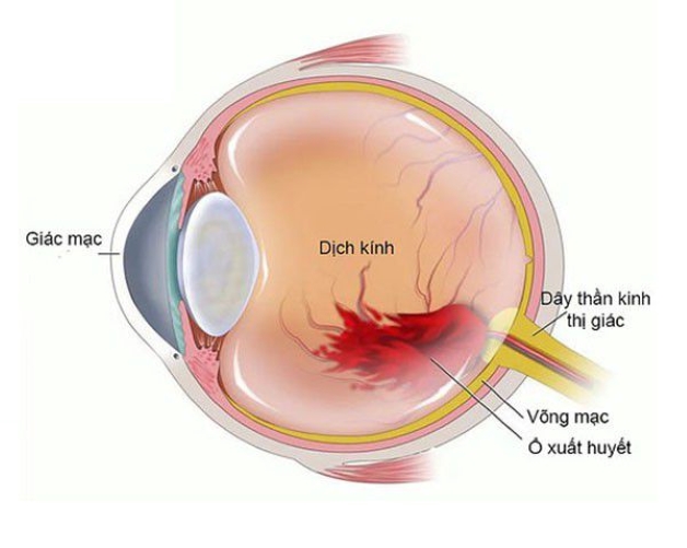 Xuất huyết dịch kính là tình trạng máu chảy và vào khoang chứa dịch kính của mắt sau đó hòa chung với dịch kính.