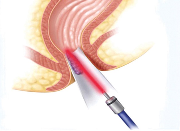 Cắt trĩ bằng phương pháp laser là dùng năng lượng laser làm phân hủy mạch máu và teo búi trĩ