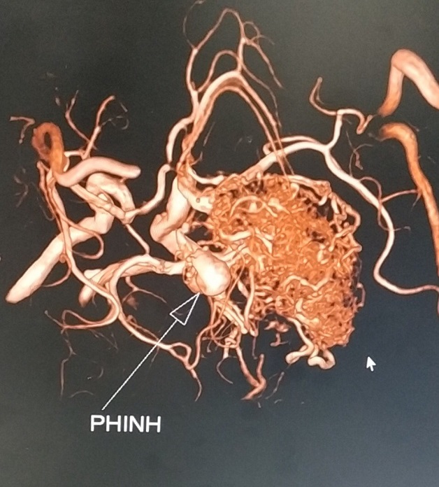 chụp cộng hưởng từ MRI phát hiện túi phình mạch não