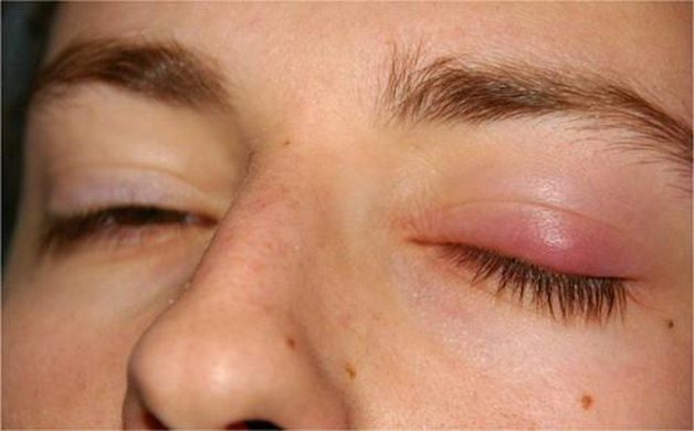 Chắp lẹo là căn bệnh thường gặp ở tất cả mọi người