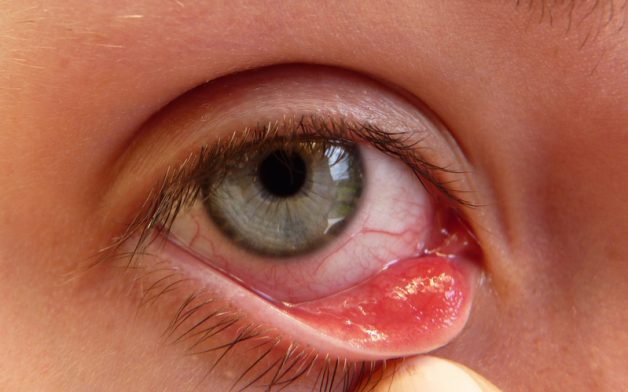 Có nhiều nguyên nhân gây ra bệnh viêm kết giác mạc mắt