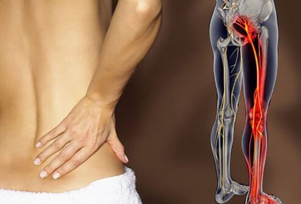 Đau thần kinh tọa là bệnh lý thường gặp ở độ tuổi từ 30 - 50