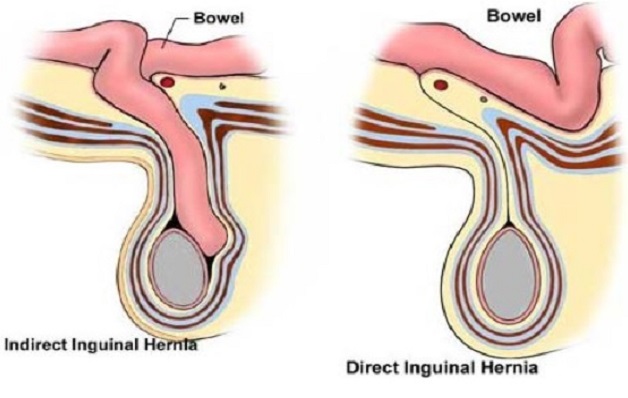 Điều trị thoát vị bẹn cần phẫu thuật để dứt điểm bệnh