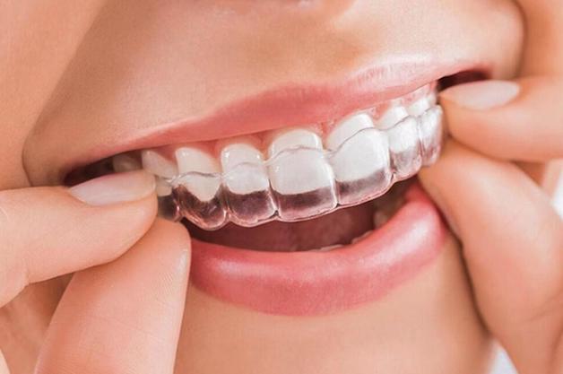 Niềng răng Invisalign là phương pháp sử dụng khay niềng trong suốt để nắn chỉnh răng