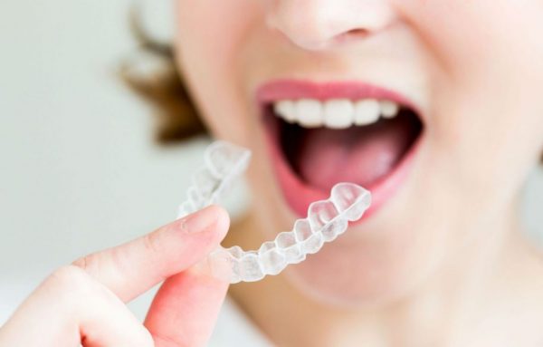 Giá niềng răng trong suốt hiện nay dao động từ 60 đến 120 triệu đồng cho một ca niềng