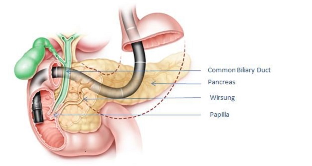 kỹ thuật nội soi mật tụy ngược dòng