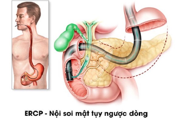 tìm hiểu về nội soi
