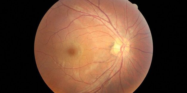 Hắc võng mạc trung tâm thanh dịch là căn bệnh lành tính