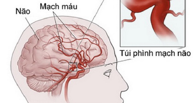 Mô tả quá trình phình mạch não diễn ra