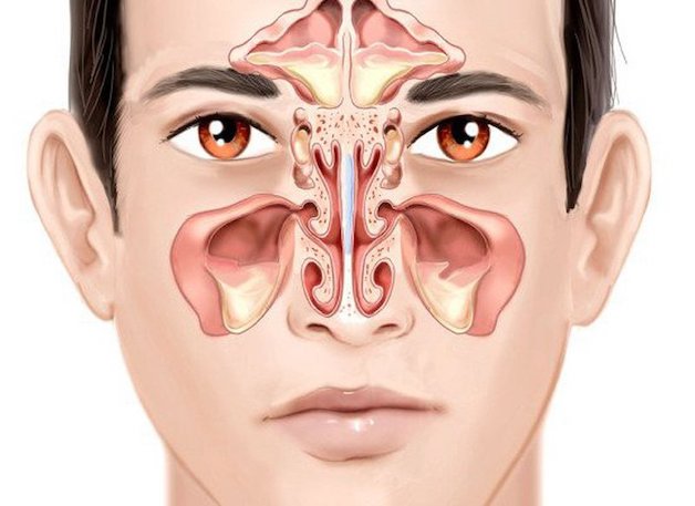 Khi những lỗ xoang bị tắc nghẽn, sự lưu thông ngưng trệ gọi là viêm xoang mũi cấp tính