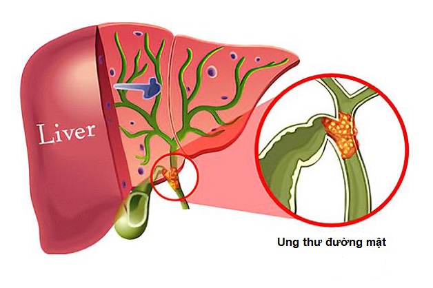Khám và điều trị ung thư đường mật như thế nào