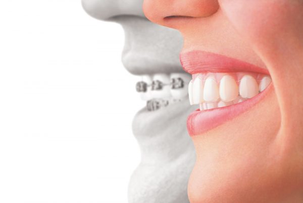 Niềng răng là phương pháp điều chỉnh vị trí răng, mang lại cho mọi người hàm răng cân đối và đều đặn