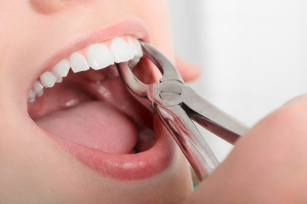 Bác sĩ chỉ định nhổ răng để niềng theo từng trường hợp cụ thể