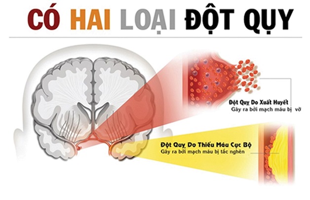 Mức độ nguy hiểm theo các loại đột quỵ 