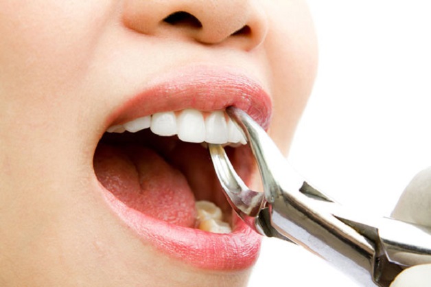 Nhổ răng cửa là chỉ định cần thiết trong một số trường hợp như răng bị sâu hay viêm nhiễm nặng, khó bảo tồn