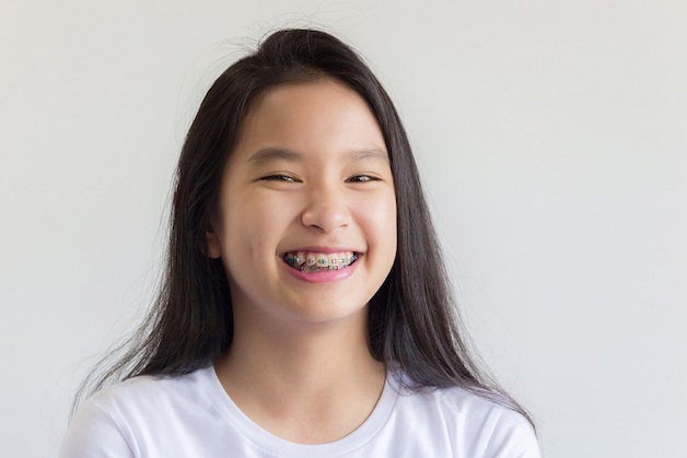 Niềng răng cho trẻ càng sớm thì hiệu quả sẽ càng cao