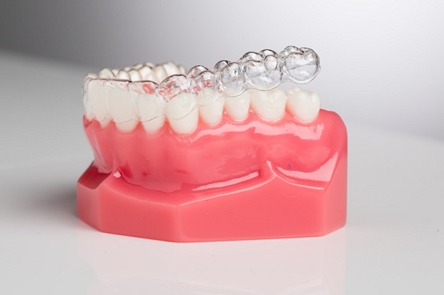 Niềng răng trong suốt sử dụng khay niềng trong suốt thay thế cho hệ thống mắc cài, dây cung