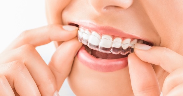 Khay niềng ôm sát vào thân răng đảm bảo thẩm mỹ cao