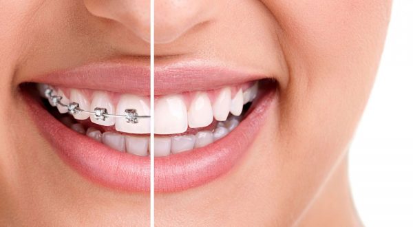 Niềng răng trước và sau không chỉ làm thay đổi diện mạo nụ cười mà còn cải thiện rõ rệt khớp cắn, khiến gương mặt có cảm giác đều đẹp, hài hòa hơn
