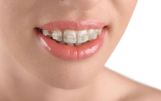 Tình trạng niềng răng xong vẫn xấu có thể xuất phát từ một số thói quen sai lầm của người niềng.