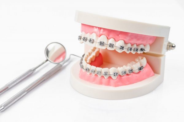 Một ca niềng răng thành công phụ thuộc vào nhiều yếu tố như: Tay nghề của bác sĩ cũng như cách chăm sóc răng miệng của người niềng