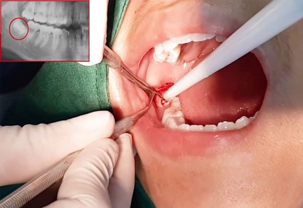 Răng số 8 bị sâu vỡ xuất phát từ nhiều nguyên nhân, chủ yếu là do người bệnh chủ quan không điều trị khi răng 8 có hiện tượng sâu