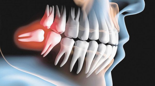 Với thắc mắc răng số 8 mọc lệch có nên nhổ không, câu trả lời là hầu hết răng số 8 mọc lệch đều được chỉ định nhổ để đảm bảo an toàn, tránh gây biến chứng nguy hiểm cho răng
