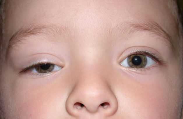 Sụp mí bẩm sinh là căn bệnh thường gặp ở trẻ em