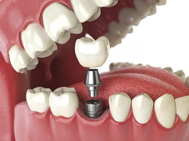 Với thắc mắc trồng răng sứ có đau không, trên thực tế, sau khi mài răng làm trụ thì bạn có thể có cảm giác hơi đau nhức