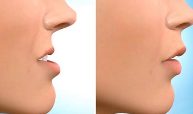 Trước và sau niềng răng, khuôn mặt sẽ có sự thay đổi nhất định