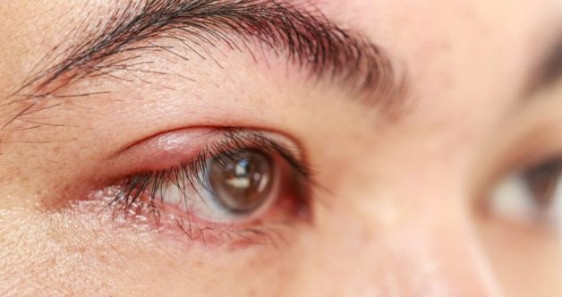 U bã đậu ở mí mắt là căn bệnh nhiều người gặp phải