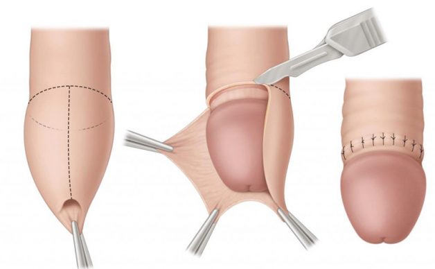 Anh em nên thực hiện cắt bao đầu quy theo chỉ định của bác sĩ