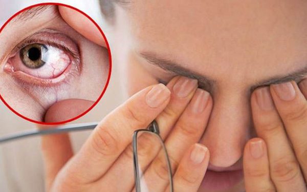 dấu hiệu bệnh khô mắt
