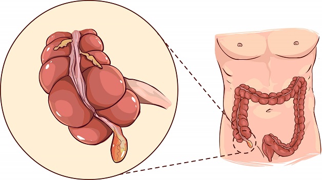 Bệnh viêm ruột thừa là cấp cứu ngoại khoa thường gặp