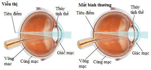 bị viễn thị