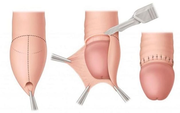 Cắt bao quy đầu là một tiểu phẫu đơn giản và diễn ra trong khoảng thời gian ngắn