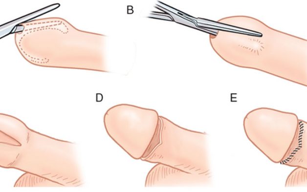 Chi phí phẫu thuật cắt bao quy đầu phụ thuộc vào nhiều yếu tố khác nhau