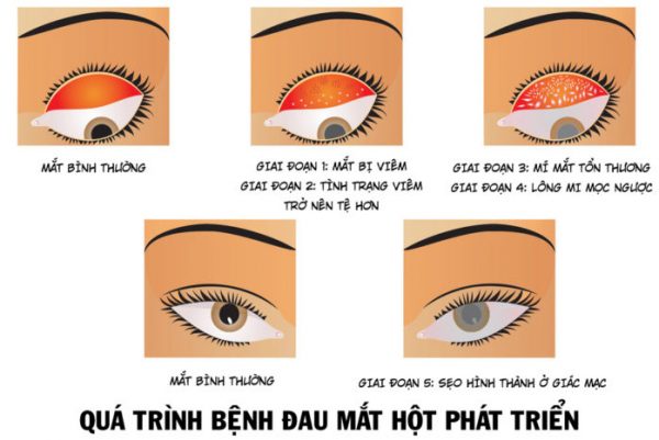 đau mắt hột