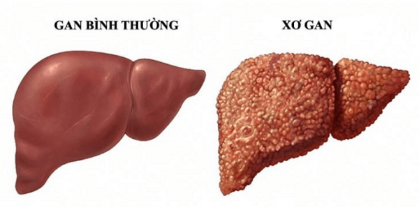 Viêm gan C có thể gây xơ gan