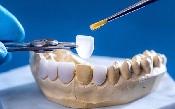 Keo dán nha khoa cố định