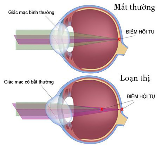 loạn thị có giảm được không