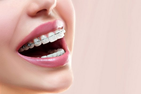 Niềng răng là phương pháp cải thiện hiệu quả các tình trạng lệch lạc của răng