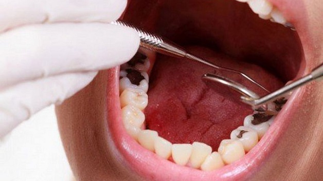 Nhổ răng số 6 hàm dưới thường được chỉ định trong những trường hợp răng bị sâu, khó bảo tồn