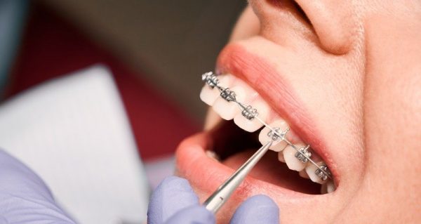 Không thể niềng 2 răng cửa thưa mà phải niềng cả hàm